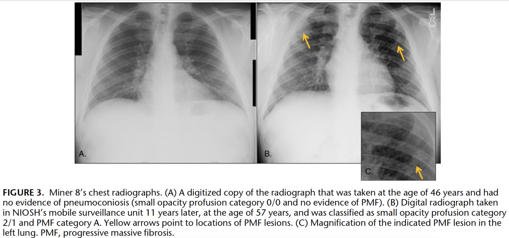 x-rays showing progression in surface miner