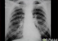 X-ray Showing Simple CWP