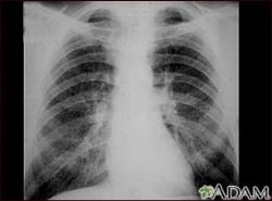 X-ray Showing Simple CWP